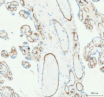 IHC staining of FFPE human liver cancer tissue with CD31 antibody. HIER: boil tissue sections in pH8 EDTA for 20 min and allow to cool before testing.