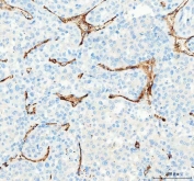 IHC staining of FFPE human liver cancer tissue with CD31 antibody. HIER: boil tissue sections in pH8 EDTA for 20 min and allow to cool before testing.