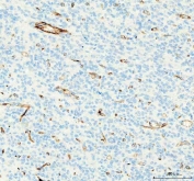 IHC staining of FFPE human glioblastoma tissue with CD31 antibody. HIER: boil tissue sections in pH8 EDTA for 20 min and allow to cool before testing.