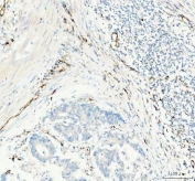 IHC staining of FFPE human colorectal adenocarcinoma tissue with CD31 antibody. HIER: boil tissue sections in pH8 EDTA for 20 min and allow to cool before testing.