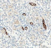 IHC staining of FFPE human testicular germ cell tumor tissue with CD31 antibody. HIER: boil tissue sections in pH8 EDTA for 20 min and allow to cool before testing.