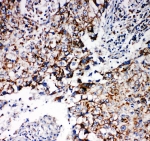 IHC-P: Prohibitin 2 antibody testing of human lung cancer tissue. HIER: steamed with pH6 citrate buffer.