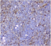 IHC staining of FFPE human sarcoma with p62 antibody. HIER: boil tissue sections in pH8 EDTA for 20 min and allow to cool before testing.