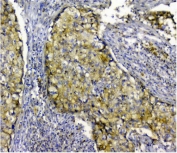 IHC staining of FFPE human lung cancer with p62 antibody. HIER: boil tissue sections in pH8 EDTA for 20 min and allow to cool before testing.