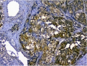 IHC staining of FFPE human stomach cancer with p62 antibody. HIER: boil tissue sections in pH8 EDTA for 20 min and allow to cool before testing.