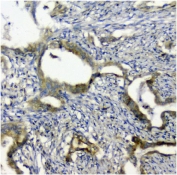 IHC staining of FFPE human rectal cancer with p62 antibody. HIER: boil tissue sections in pH8 EDTA for 20 min and allow to cool before testing.