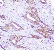 IHC staining of FFPE human cholangiocarcinoma with p62 antibody. HIER: boil tissue sections in pH8 EDTA for 20 min and allow to cool before testing.