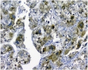 IHC staining of FFPE human liver cancer with p62 antibody. HIER: boil tissue sections in pH8 EDTA for 20 min and allow to cool before testing.