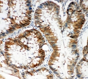 IHC staining of FFPE intestinal cancer with p62 antibody. HIER: boil tissue sections in pH6 citrate buffer for 20 min and allow to cool before testing.