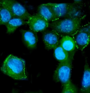 IHC-P: ZO-2 antibody testing of human intestinal cancer tissue
