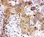 IHC staining of FFPE human glioma tissue with SIP1 antibody. HIER: boil tissue sections in pH6 citrate buffer for 20 min and allow to cool before testing.