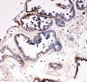 IHC staining of FFPE human ovarian cancer with VISA antibody. HIER: boil tissue sections in pH6, 10mM citrate buffer, for 20 min and allow to cool before testing.