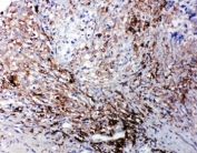 IHC-P: LTBR antibody testing of human intestinal cancer tissue