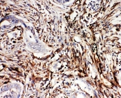 IHC-P: NRG1 antibody testing of human intestinal cancer tissue. HIER: steamed with pH6 citrate buffer.