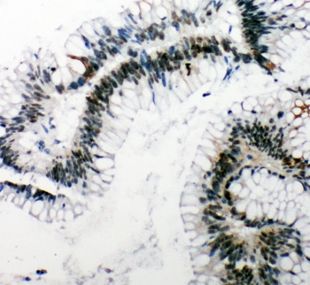 IHC-P: 53BP1 antibody testing of human intestinal cancer tissue. HIER: steamed with pH6 citrate buffer.