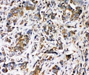 IHC-P: TRPV2 antibody testing of human intestine cancer tissue