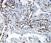 IHC-P: VEGFR2 antibody testing of human lung cancer tissue