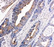 IHC-P: Tec antibody testing of human intestinal cancer tissue