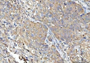 IHC staining of FFPE human lung cancer tissue with Tollip antibody. HIER: boil tissue sections in pH8 EDTA for 20 min and allow to cool before testing.