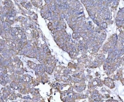 IHC staining of FFPE human ovarian cancer tissue with Tollip antibody. HIER: boil tissue sections in pH8 EDTA for 20 min and allow to cool before testing.
