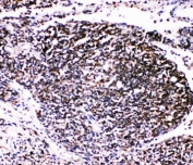 IHC-P: TRAF4 antibody testing of human lung cancer tissue. HIER: steamed with pH6 citrate buffer.