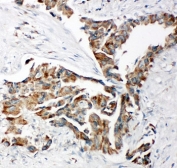 IHC-P: TRAM antibody testing of human lung cancer tissue. HIER: steamed with pH6 citrate buffer.