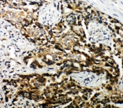 IHC-P: TSC1 antibody testing of human breast cancer tissue
