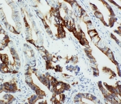 IHC-P: CYP2U1 antibody testing of human intestinal cancer tissue