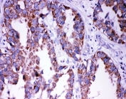 IHC-P: DISC1 antibody testing of human lung cancer tissue. HIER: steamed with pH6 citrate buffer.