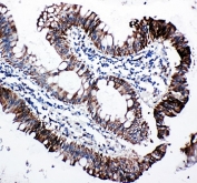 IHC-P: EIF2S1 antibody testing of human intestine cancer tissue