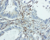 IHC-P: EIF6 antibody testing of human intestine cancer tissue (1)