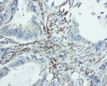 IHC-P: EIF6 antibody testing of human intestine cancer tissue