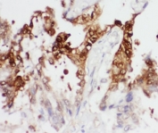 IHC-P: PGK1 antibody testing of human lung cancer tissue. HIER: steamed with pH6 citrate buffer.