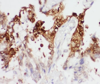 IHC-P: PGK1 antibody testing of human lung cancer tissue.