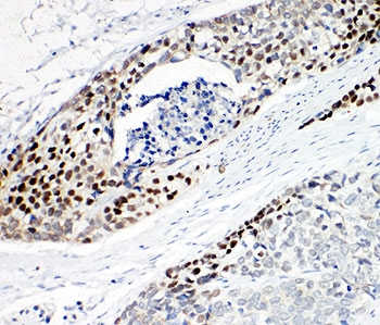 IHC-P: p63 antibody testing of human esophageal squamous cell carcinoma tissue