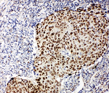 IHC-P testing of human lung cancer tissue