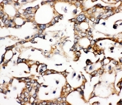 IHC-P: ALDH2 antibody testing of human liver cancer tissue