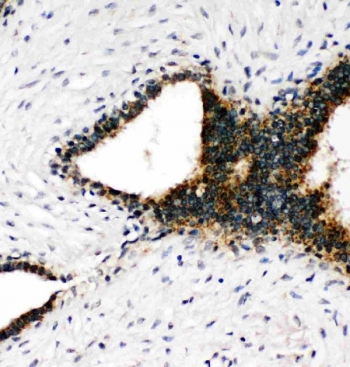 IHC staining of FFPE human breast cancer tissue with Annexin VII antibody. HIER: boil tissue sections in pH8 EDTA for 20 min and allow to cool before testing.