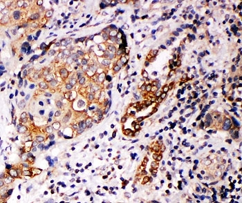 IHC-P: Annexin A10 antibody testing of human lung cancer tissue