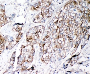 IHC-P: VE Cadherin antibody testing of human lung cancer tissue