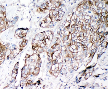 IHC-P: VE-Cadherin antibody testing of human lung cancer tissue