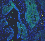 Immunofluorescent staining of FFPE human colon cancer with Proprotein Convertase 1/3 antibody (green) and DAPI nuclear counterstain (blue). HIER: boil tissue sections in pH6, 10mM citrate buffer, for 10-20 min and allow to cool before testing.