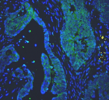 Immunofluorescent staining of FFPE human colon cancer with Proprotein Convertase 1/3 antibody (green) and DAPI nuclear counterstain (blue). HIER: boil tissue sections in pH6, 10mM citrate buffer, for 10-20 min and allow to cool before testing.