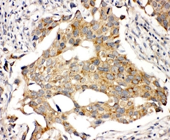 IHC-P: Prolactin Receptor antibody testing of human breast cancer tissue. HIER: steamed with pH6 citrate buffer.