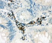 IHC-P: SPARCL1 antibody testing of human intestine cancer tissue. HIER: steamed with pH6 citrate buffer.
