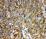 IHC-P: Aquaporin 6 antibody testing of human lung cancer tissue