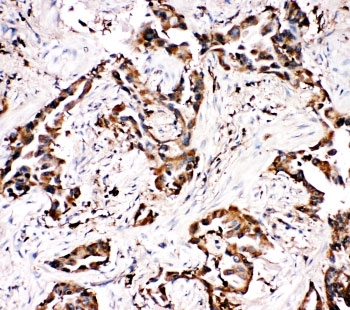 IHC-P: APLP1 antibody testing of human lung cancer tissue. Required HIER: steam section in pH6 citrate buffer for 20 min and allow to cool prior to tetsting.