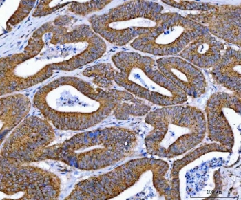 IHC staining of FFPE human rectal cancer tissue with Ataxin-2 antibody. HIER: boil tissue sections in pH8 EDTA for 20 min and allow to cool before testing.