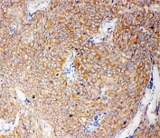 IHC-P: Caspase-12 antibody testing of human lung cancer tissue