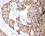 IHC-P: Caspase-12 antibody testing of human breast cancer tissue
